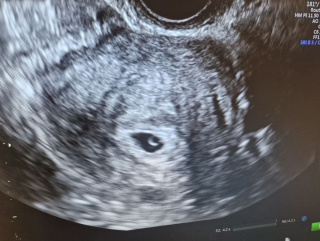 Когда один здоровый эмбрион может изменить всё